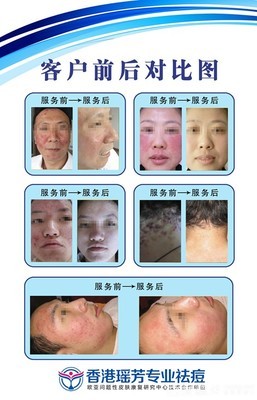 【香港瑤芳9點9元祛痘團購】_泉州國貿商城香港瑤芳專業祛痘團購10元_糯米麗人團購